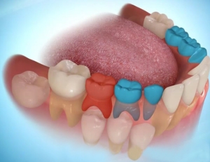 اهمية حافظة المسافة ، خلع الاسنان اللبنية Hinh-1