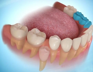 اهمية حافظة المسافة ، خلع الاسنان اللبنية Hinh-2