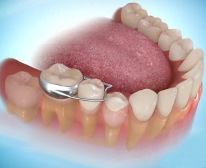 اهمية حافظة المسافة ، خلع الاسنان اللبنية Hinh-4