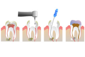 تسوس الاسنان ، علاج تسوس الاسنان 2