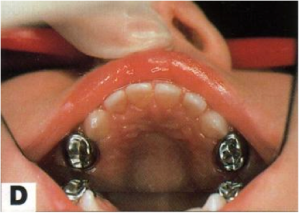 تسوس الاسنان ، علاج تسوس الاسنان 3