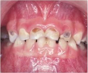 تسوس الاسنان ، علاج تسوس الاسنان 5